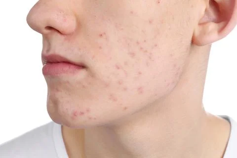 Young man with acne problem isolated on white, closeup 스톡 사진
