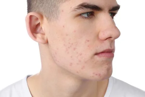 Young man with acne problem isolated on white, closeup 스톡 사진