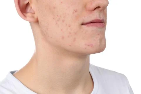Young man with acne problem isolated on white, closeup 스톡 사진