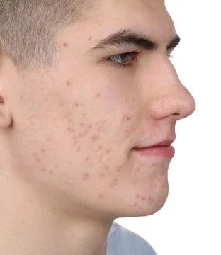 Young man with acne problem isolated on white, closeup 스톡 사진