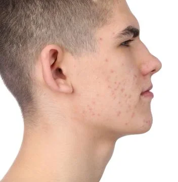 Young man with acne problem isolated on white 스톡 사진