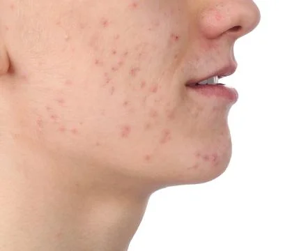 Young man with acne problem isolated on white, closeup 스톡 사진
