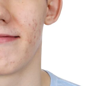 Young man with acne problem isolated on white, closeup 스톡 사진