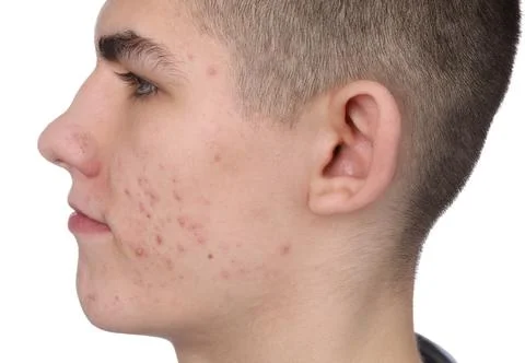 Young man with acne problem isolated on white 스톡 사진