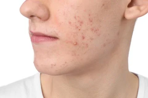 Young man with acne problem isolated on white, closeup 스톡 사진