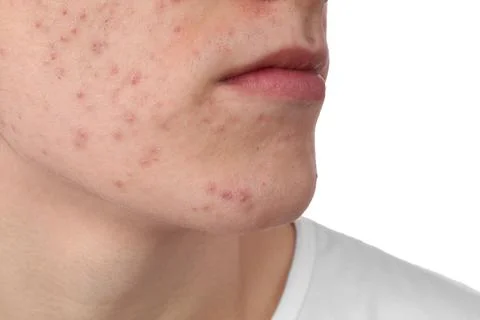 Young man with acne problem isolated on white, closeup 스톡 사진