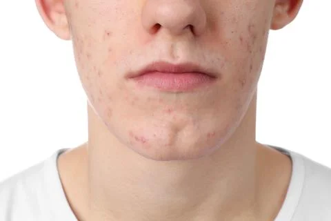 Young man with acne problem isolated on white, closeup 스톡 사진