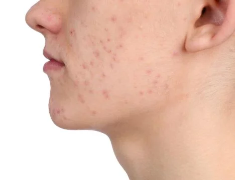 Young man with acne problem isolated on white, closeup 스톡 사진