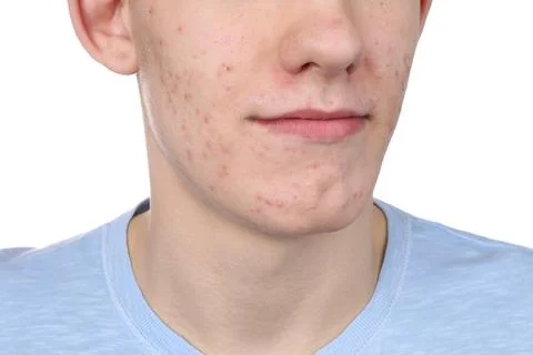 Young man with acne problem isolated on white, closeup 스톡 사진