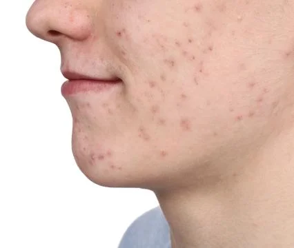 Young man with acne problem isolated on white, closeup 스톡 사진