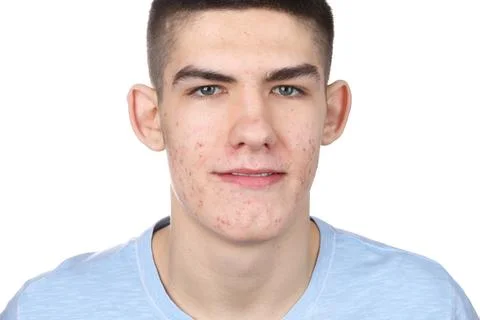 Young man with acne problem isolated on white 스톡 사진