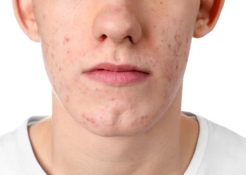 Young man with acne problem isolated on white, closeup 스톡 사진