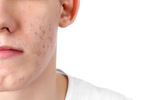 Young man with acne problem isolated on white, closeup 스톡 사진
