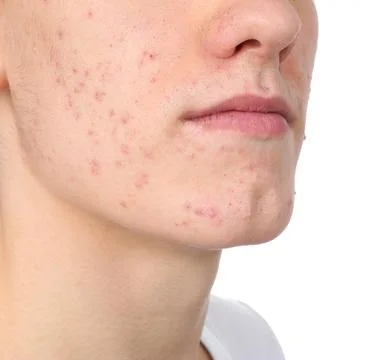 Young man with acne problem isolated on white, closeup 스톡 사진