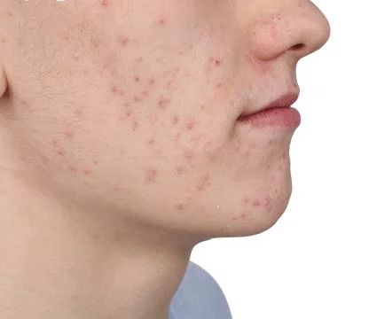 Young man with acne problem isolated on white, closeup 스톡 사진
