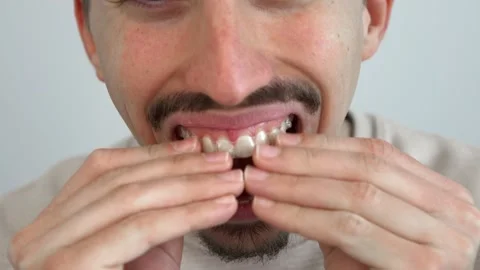 Young man adjusting and placing invisible silicone aligner for dental correction Stock Footage 172384235