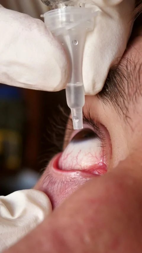 A young man applying eye drops. Effective medications for young people Stock Footage 336053735