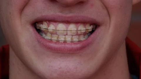 A young man with braces Stock Photos