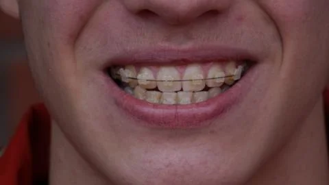 A young man with braces Stock Photos