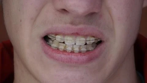 A young man with braces Stock Photos