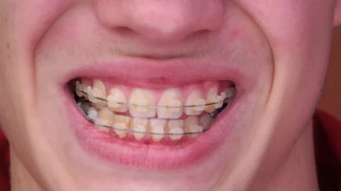 A young man with braces Smiling, laughing Video stock 75892743