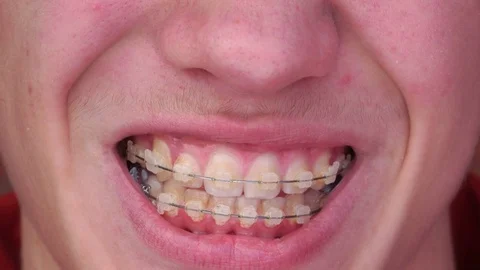 A young man with braces Smiling, laughing Video stock 75893472