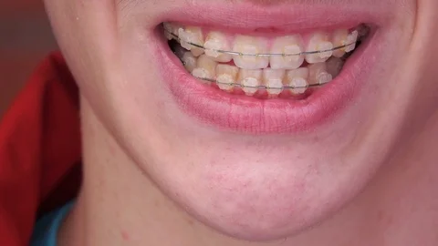 A young man with braces Smiling, laughing Video stock 75894911