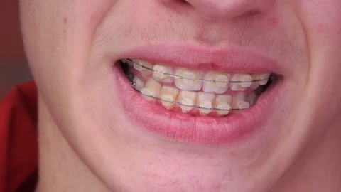 A young man with braces Smiling, laughing Stock Footage 75896280