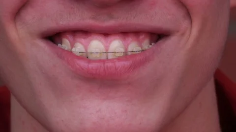 A young man with braces Smiling, laughing Video stock 75897459