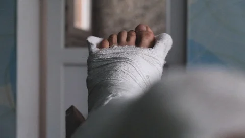 Young man with broken plaster leg Stock Footage 121667805