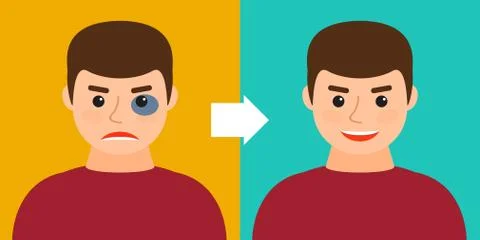 Young man with a bruise or without. Before and after. Stock Illustration