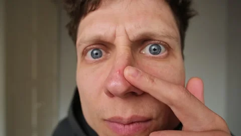 Young man closely examines a red pimple on his nose with dissatisfaction, his Stock Footage 305242356