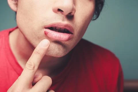 Young man with cold sore Stock Photos
