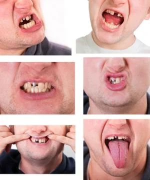 Young man face with broken tooth Stock Photos