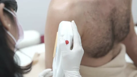Young man getting arm and shoulder laser hair removal epilation. IPL treatment 스톡 동영상 141779338