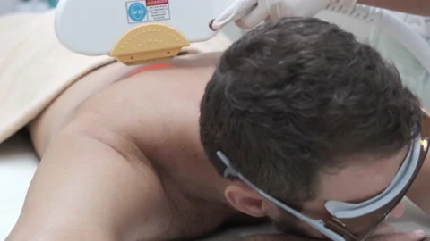 Young man getting back and shoulder laser hair removal epilation. IPL treatment 스톡 동영상 141781370