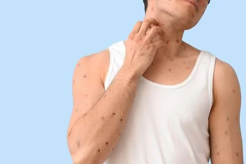 Young man ill with chickenpox scratching his body on blue background Stock Photos