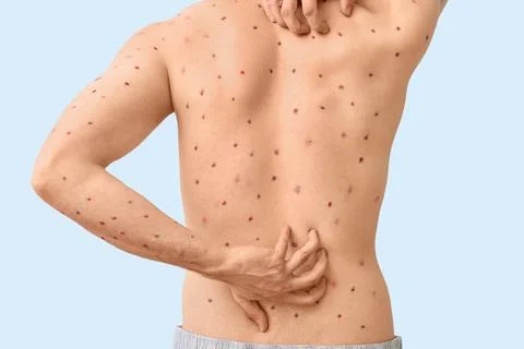 Young man ill with chickenpox scratching his back on blue background Stock Photos