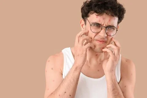 Young man ill with chickenpox scratching his body on beige background Stock Photos