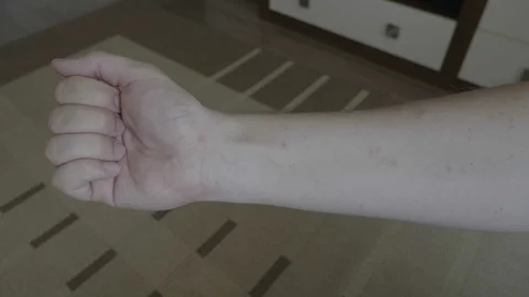 Young man looking on his arm with smallpox viral disease marks on skin Stock Footage 101955119