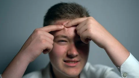 Young man squeezes the pimple on the face in front of the mirror. Closeup man's Stock-Footage 91447623