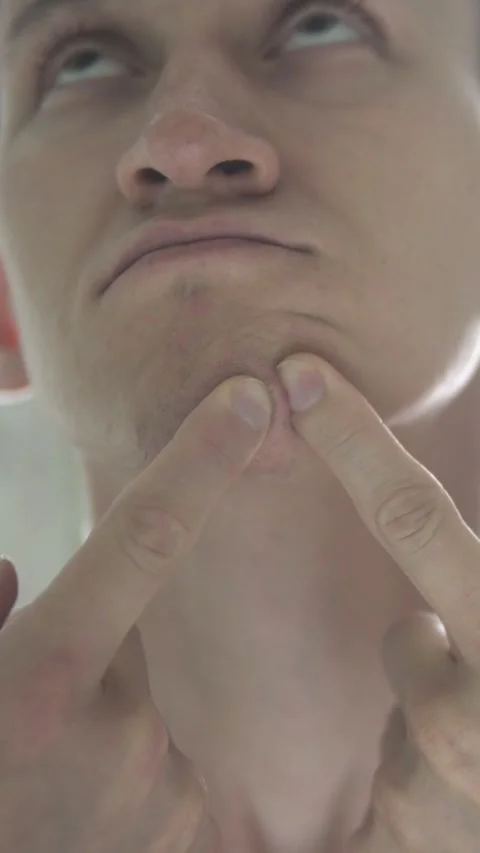 Young man squeezing a pimple on his chin in front of a mirror, representing Stock-Footage 341678498