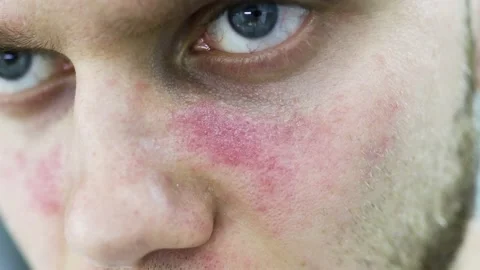 Young man suffers from systemic lupus erythematosus, age spots of redness Stock Footage 139313564