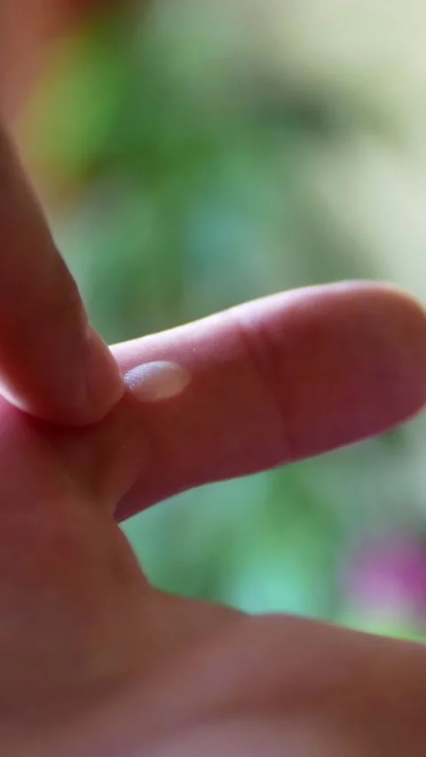 Young man touching a big blister or dropsy on the thumb of his left hand Stock Footage 294985143