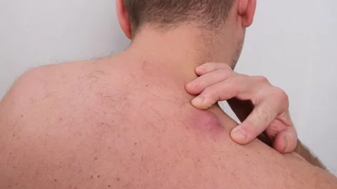 Young man trying to squeeze a large, red, and inflamed atheroma on his back, a Stock-Footage 337723329