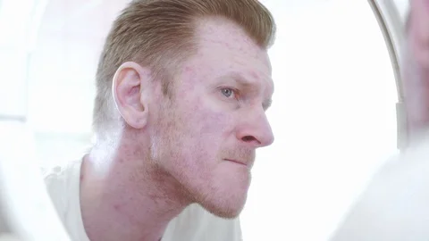 Young man washes face and notice rash Stock Footage 108517688