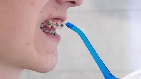 A young unrecognizable man with braces cleaning his teeth with oral irrigator. Vidéo 195794538