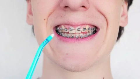 A young unrecognizable man with braces cleaning his teeth with oral irrigator. Stock Footage 246979845