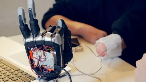 Young woman without arm using adjustable bionic prosthetic for the first time Stock Footage 73299847