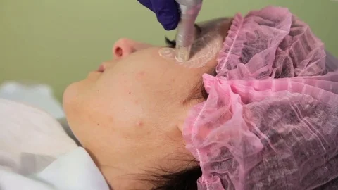 The young woman's face during the procedure closeup. Innovative cosmetic Video stock 83608847